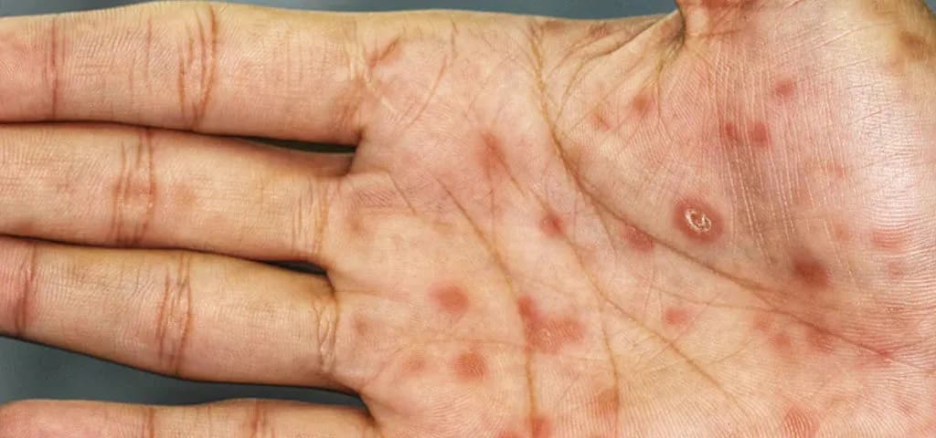 Kiła objawy zdjęcia – jak rozpoznać syfilis i uniknąć powikłań