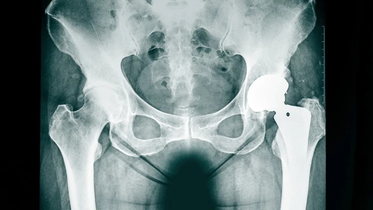 Jak długo odczuwa się ból po endoprotezie biodra? Oczekiwania i fakty