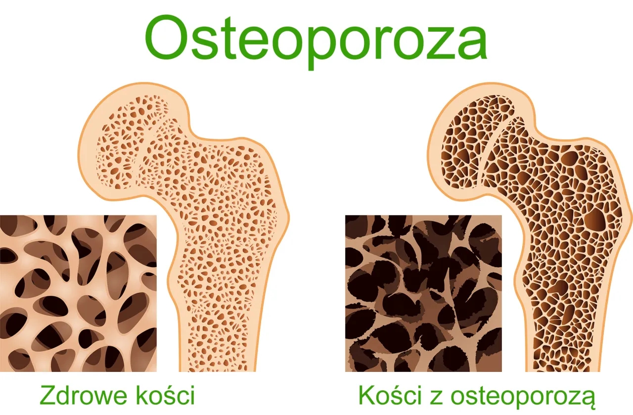 Brak wapnia objawy - poznaj niebezpieczne symptomy niedoboru