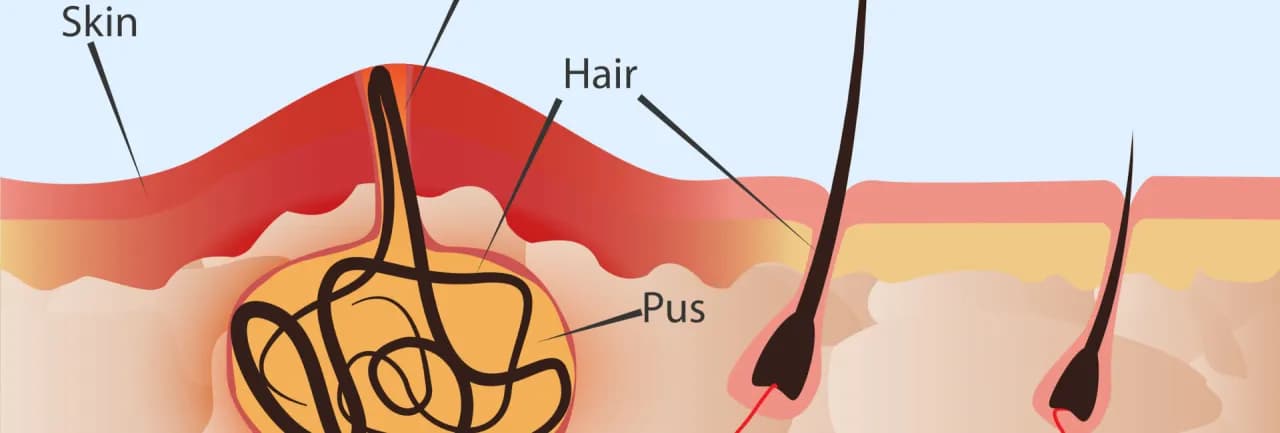 Torbiel włosowa jaki lekarz - Jak uniknąć poważnych komplikacji?