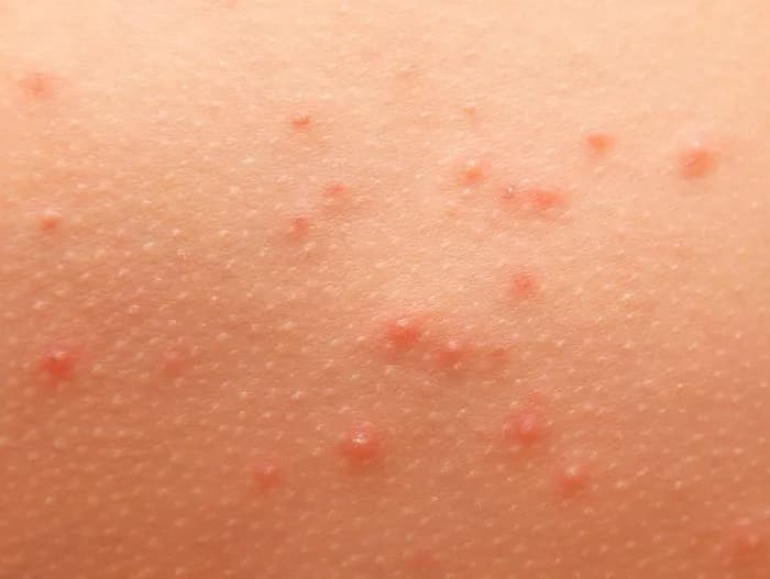 Alergia pokarmowa objawy na skórze – rozpoznaj niebezpieczne symptomy