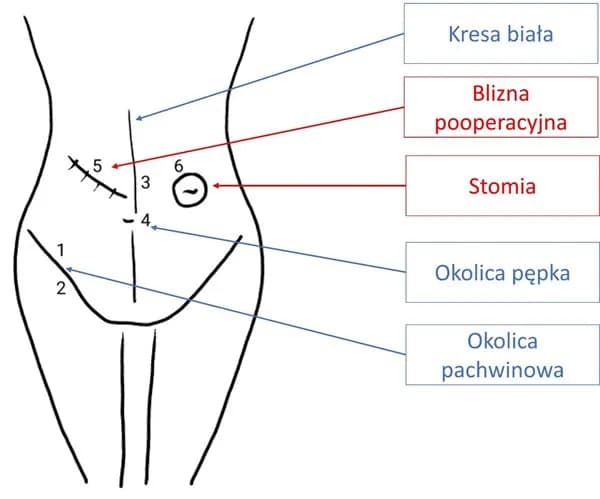 Przepuklina pachwinowa do jakiego lekarza? Kluczowe informacje dla pacjentów