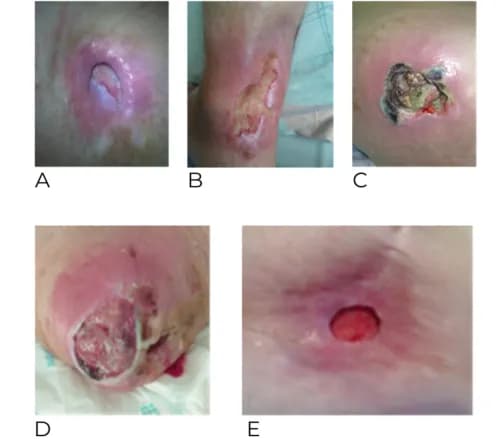 Zakażona krew objawy: jak rozpoznać niebezpieczne symptomy