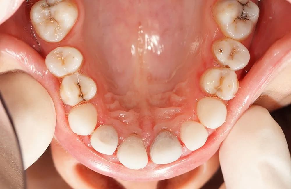 Jak zapobiec próchnicy – 7 skutecznych sposobów na zdrowe zęby