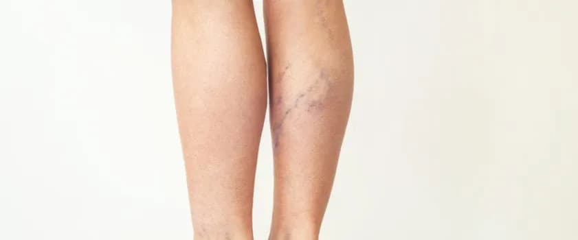 Zapalenie żył objawy: Jak rozpoznać i uniknąć poważnych problemów