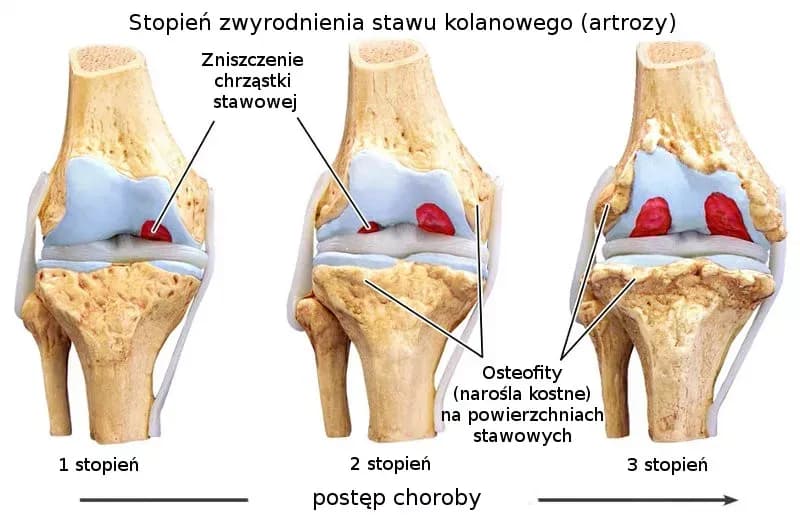 Skuteczne metody na ból kolana przy zmianach zwyrodnieniowych