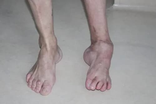 Heine Medina objawy - jak rozpoznać chorobę i uniknąć powikłań