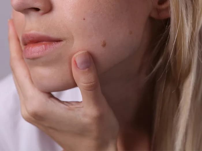 Skąd się biorą pieprzyki? Odkryj przyczyny i zagrożenia zdrowotne