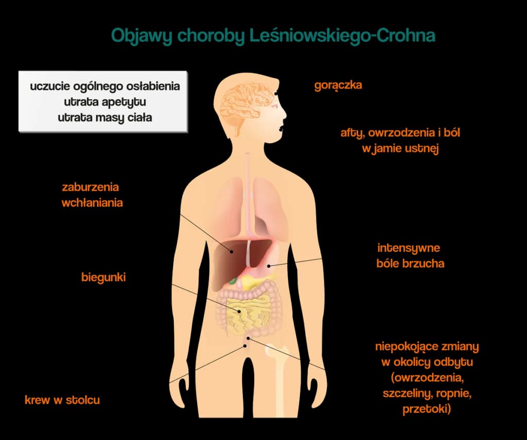 Choroba Leśniowskiego-Crohna: objawy w jamie ustnej, które musisz znać