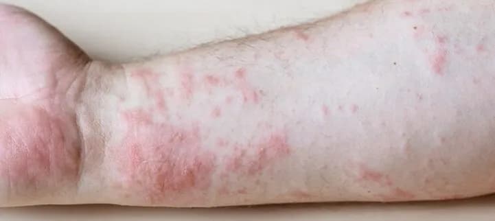 Jakie leki na rumień guzowaty skutecznie łagodzą objawy i ból